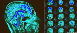 Un atlas de 6,3 millones de células abre una nueva ventana para entender el Alzheimer y otras enfermedades cerebrales